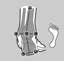 Überpronation, Einwärts-Rotation des Fußes um die Längsachse, Fußfehlstellung, Bindegewebe- bzw. Muskelschwäche, Senkfuß, Plattfuß, Übergewicht, Ermüdung, Sensomotorische Einlagen
